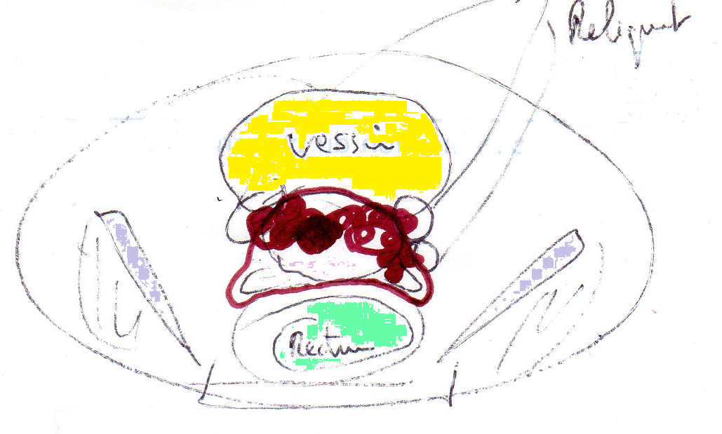 Martin ELdessinProstateVessieRectum
